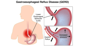 What Is GERD? How to treat the problem and overcome the symptoms?