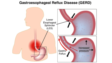 What Is GERD? How to treat the problem and overcome the symptoms?